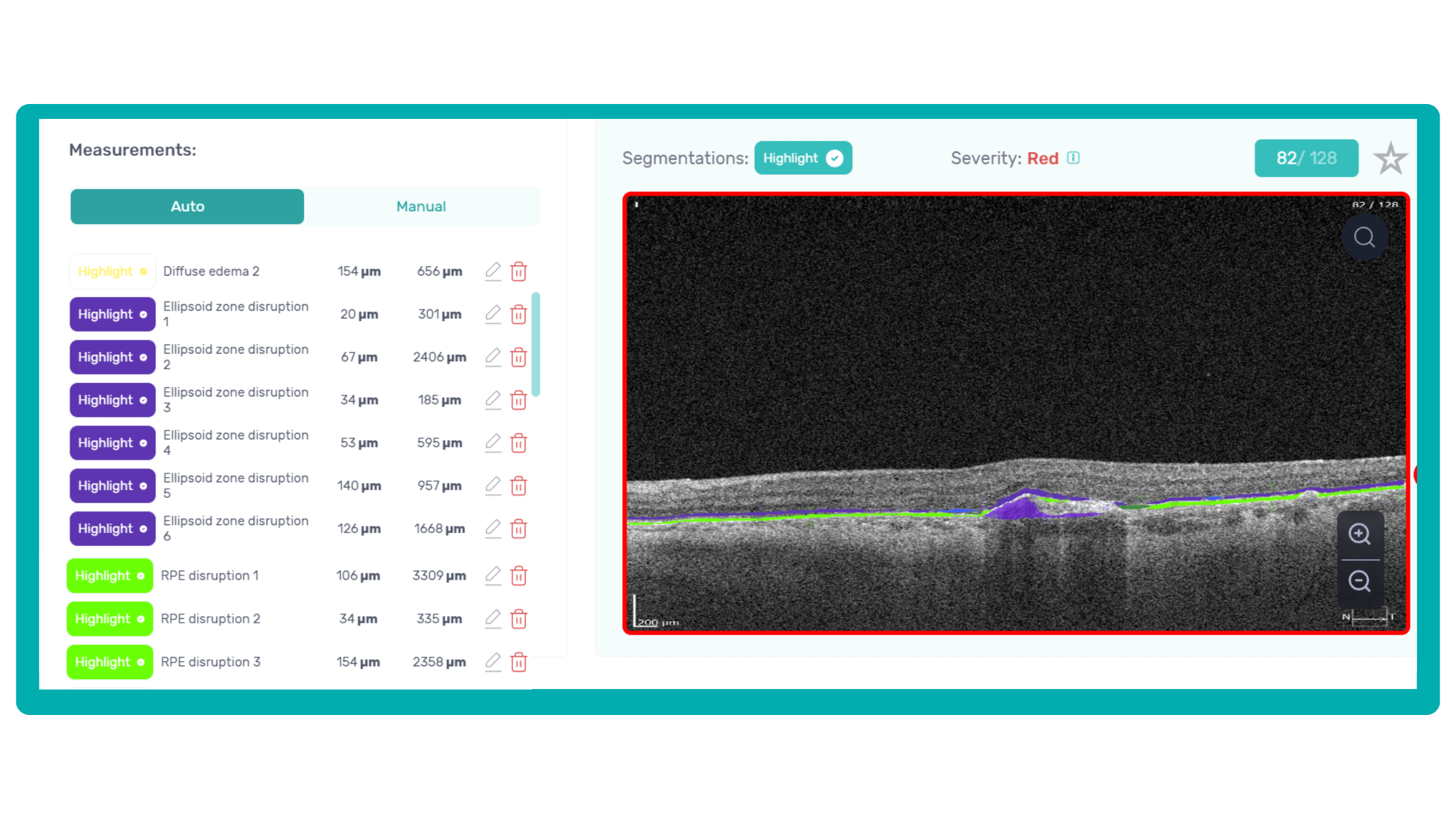 Biomarkers measuring on Altris AI customisable OCT reports