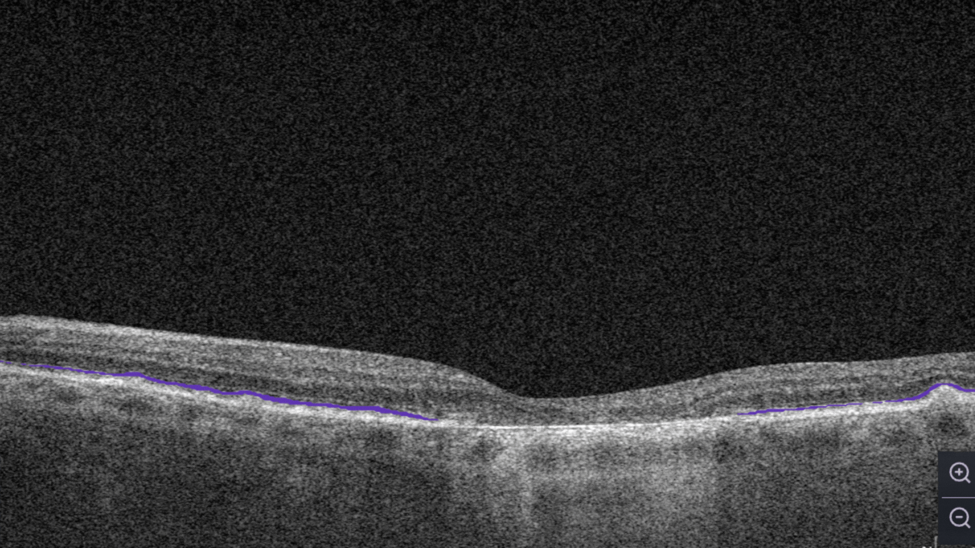 OCT Optometry: AI for OCT detection of Ellipsoid zone disruption