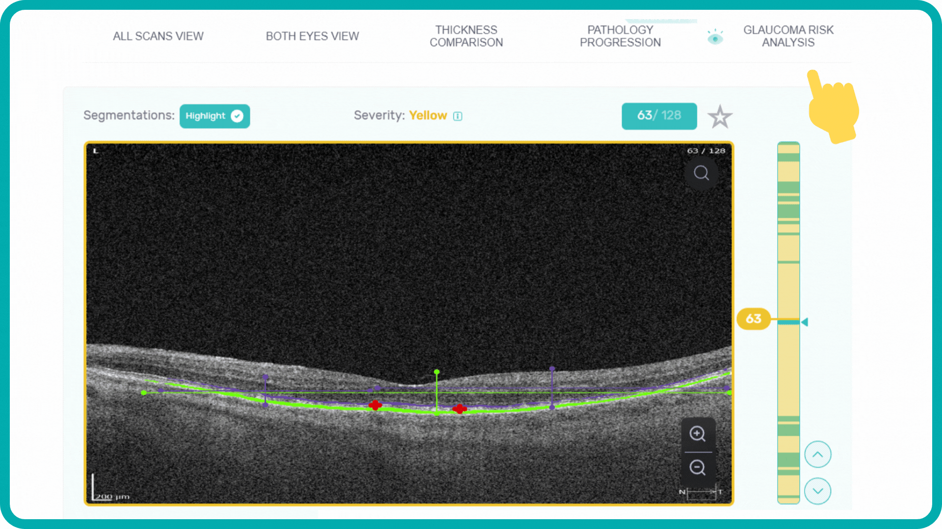 OCT Optometry: GCC Analysis and GCC Asymmetry analysis for early glaucoma risk assessment
