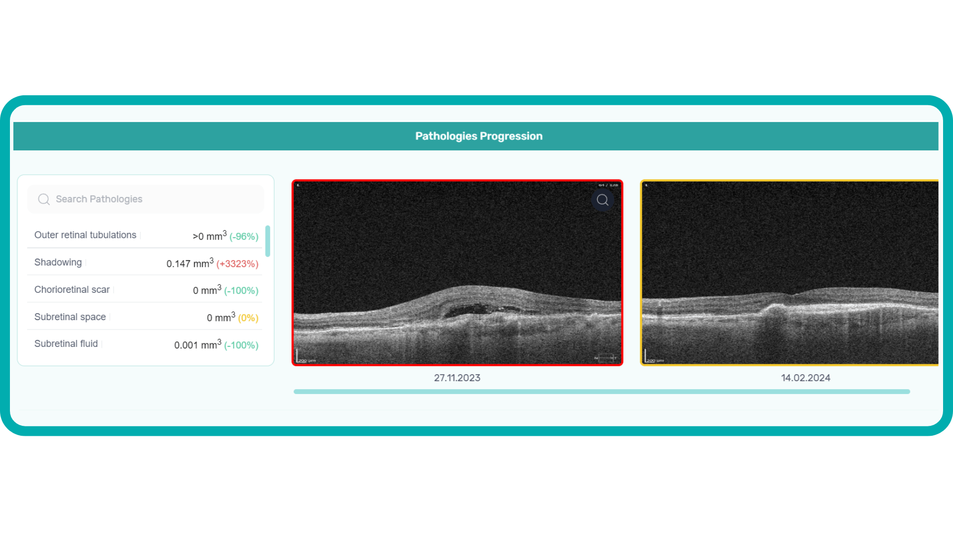 Pathology Progression, part of Altris AI customisable OCT reports