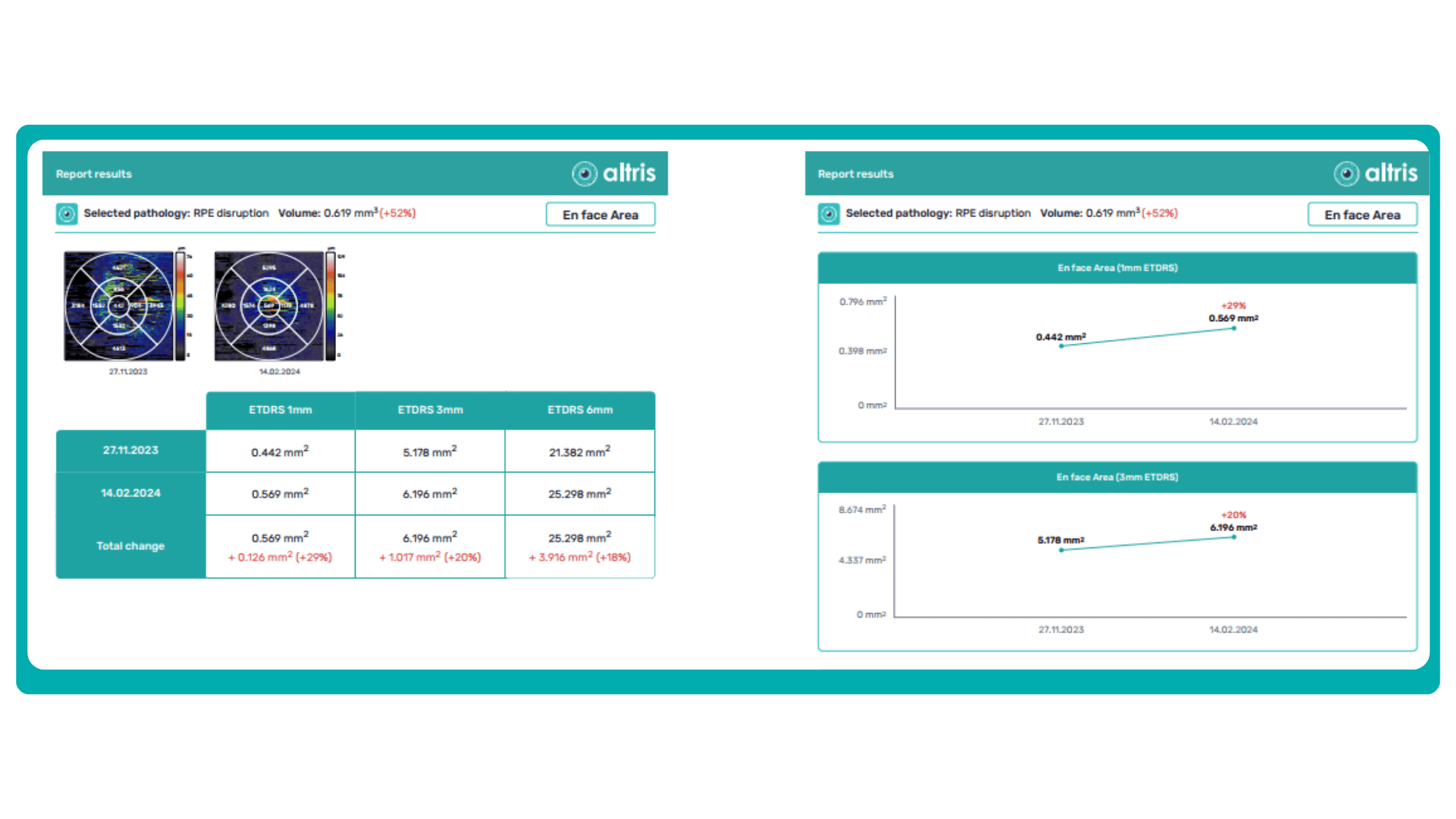 Monitoring RPE disruption progression on OCT with Altris AI
