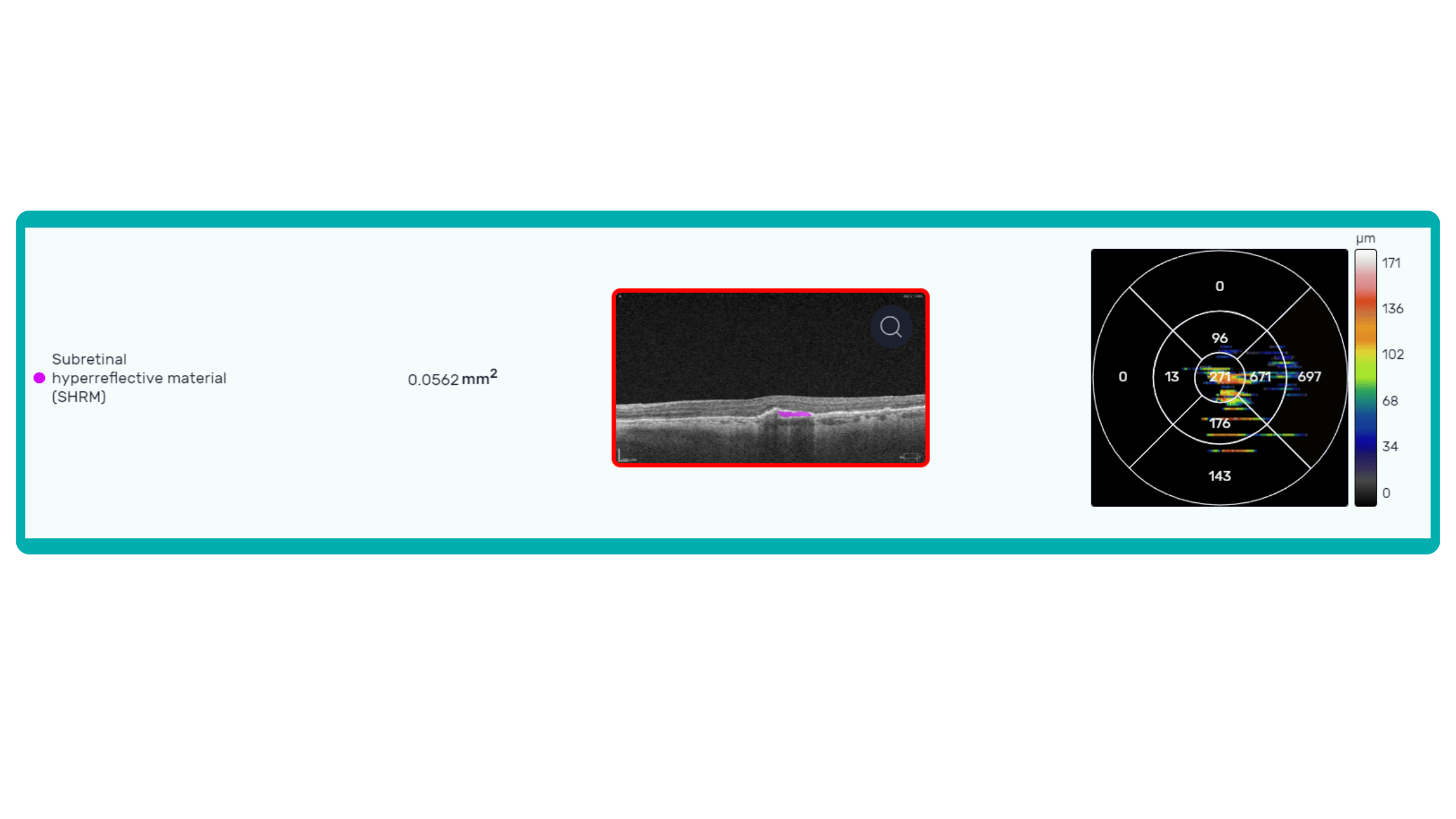subretinal hyperreflective material calculated by AI with ALtris AI 