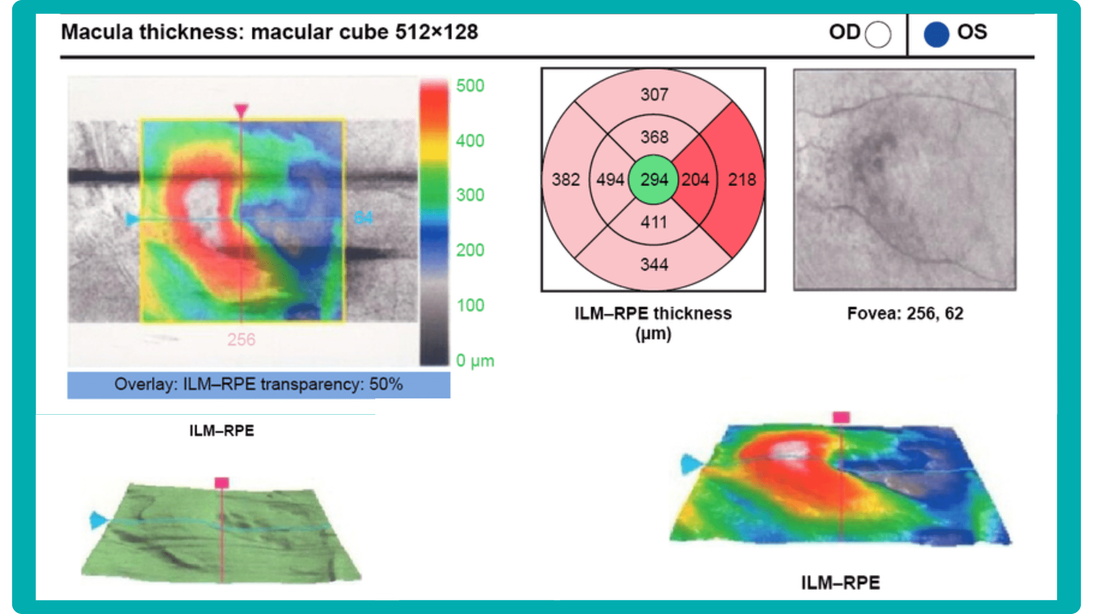  ILM and RPE layers on OCT report