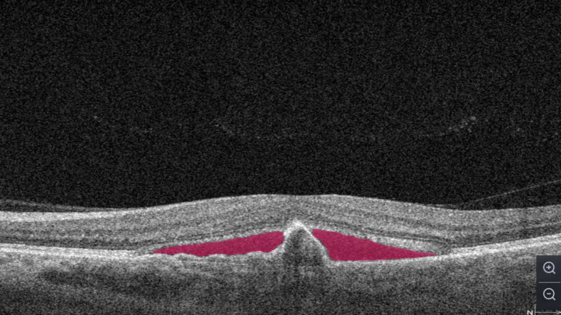 OCT Optometry: AI for OCT detection of Subretinal fluid