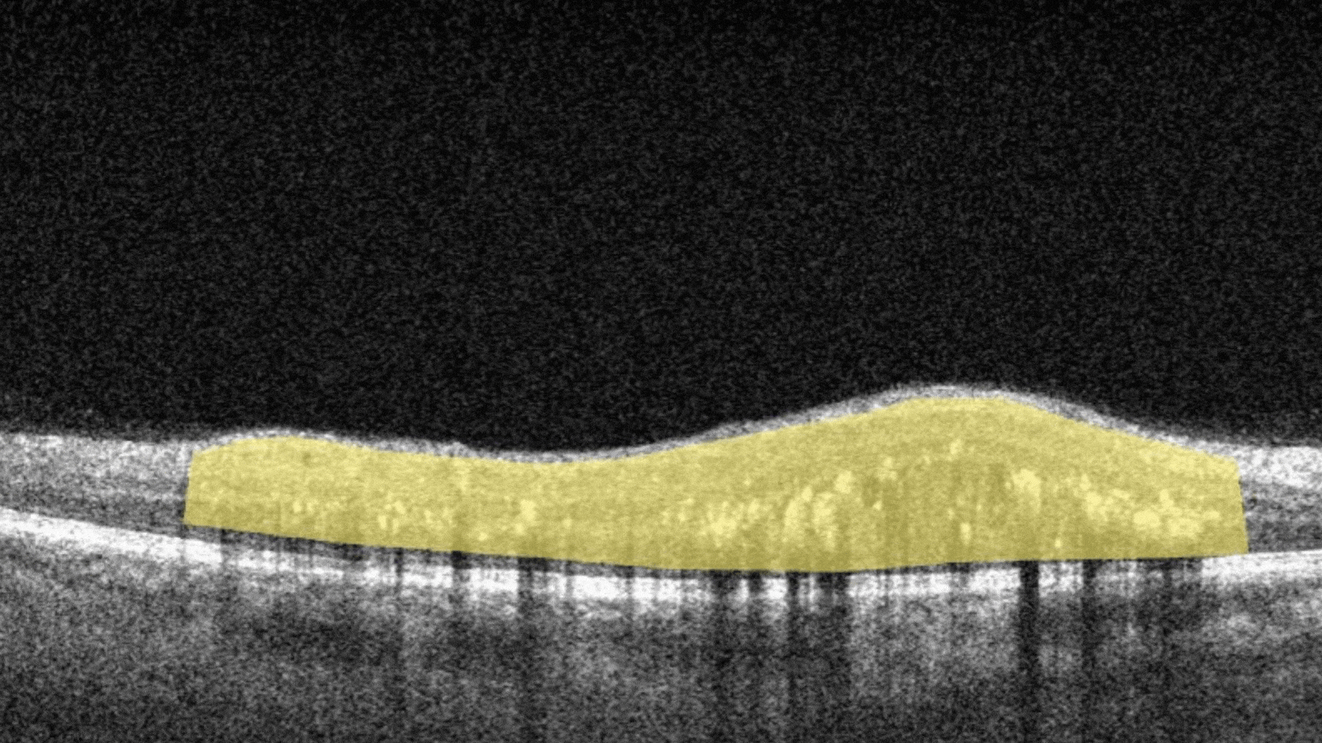 Biomarker of Diabetic Retinopathy, Diffuse Edema