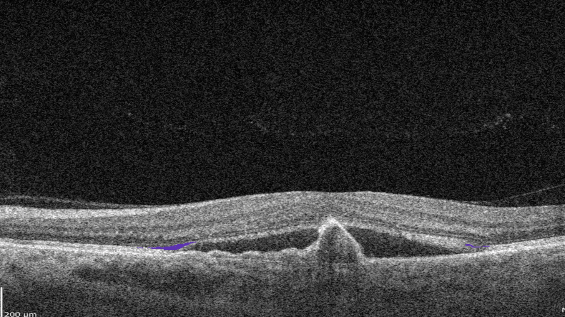 OCT Optometry: AI for OCT detection of Ellipsoid zone disruption