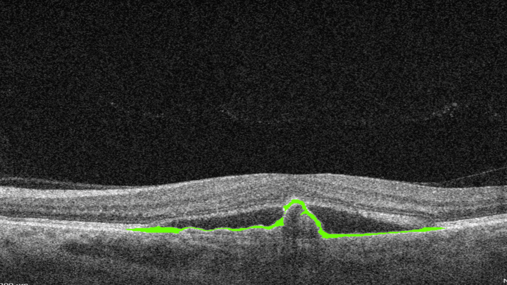 OCT Optometry: AI for OCT detection of RPE disruption