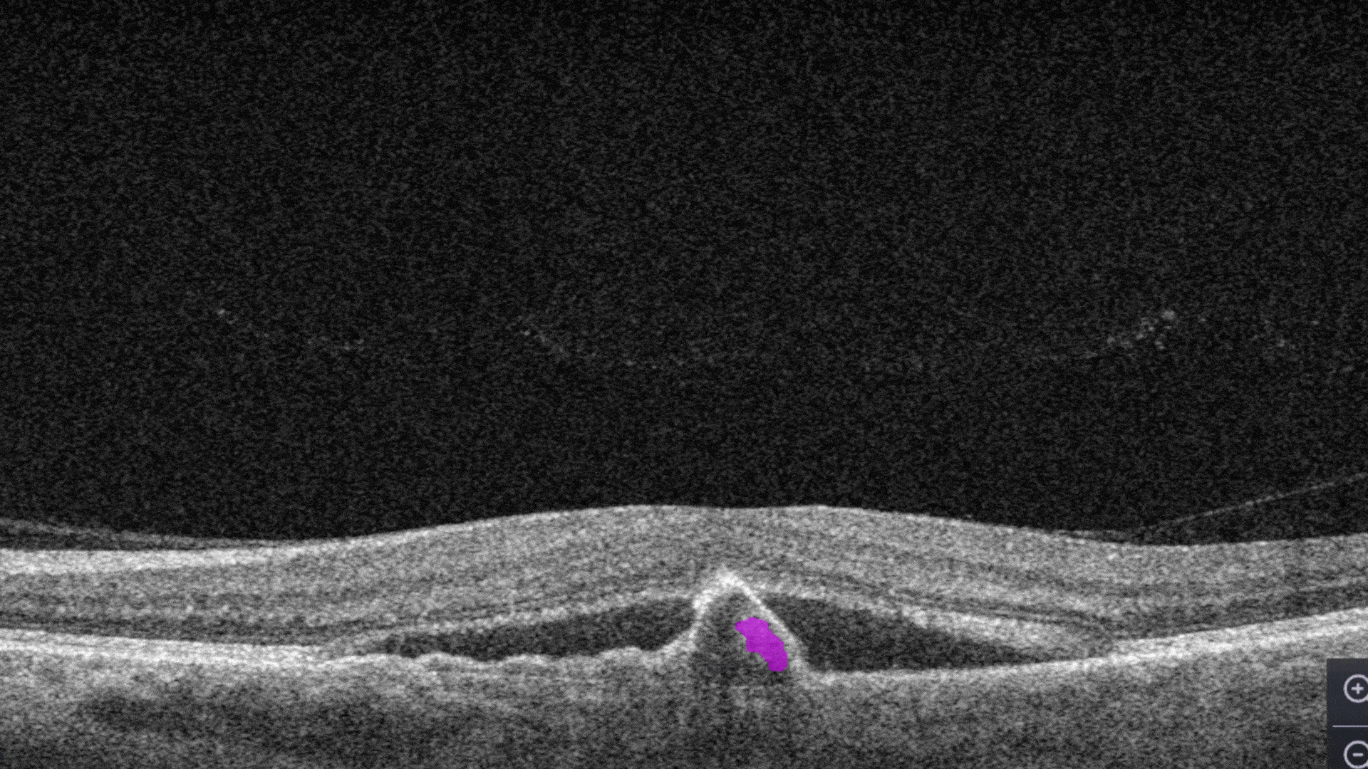 OCT Optometry: AI for OCT detection of Subretinal hyperreflective material