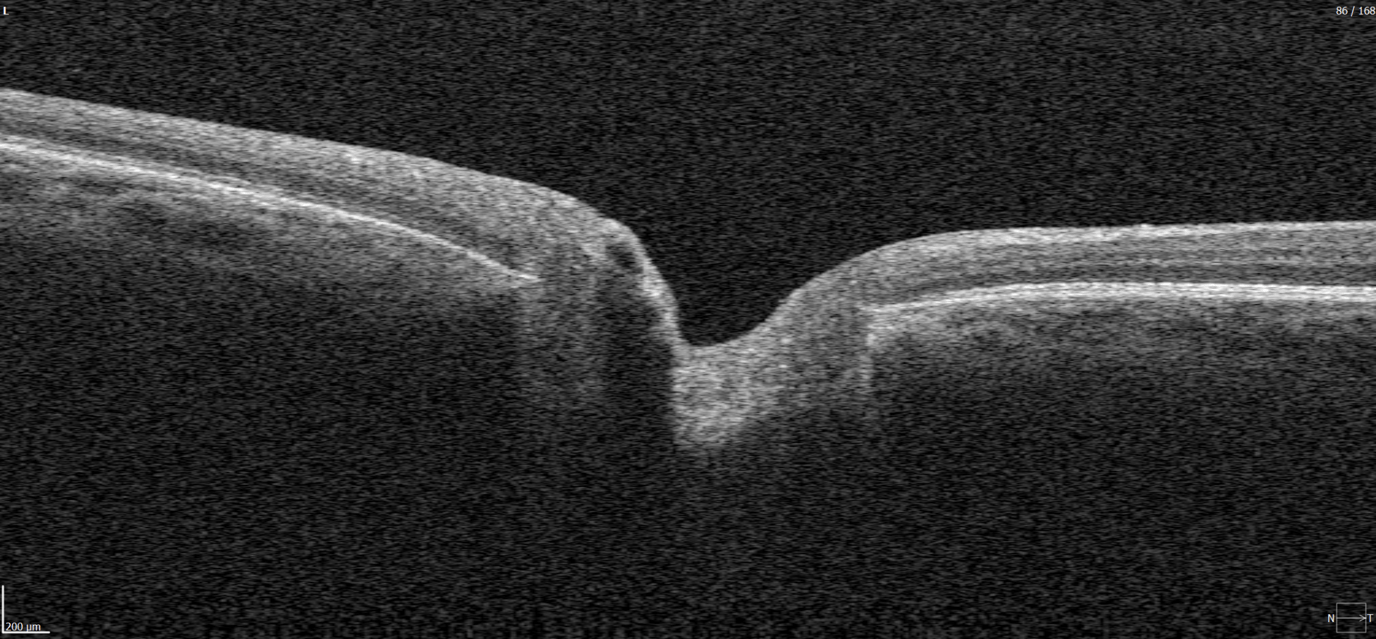 disc likelihood damage oct