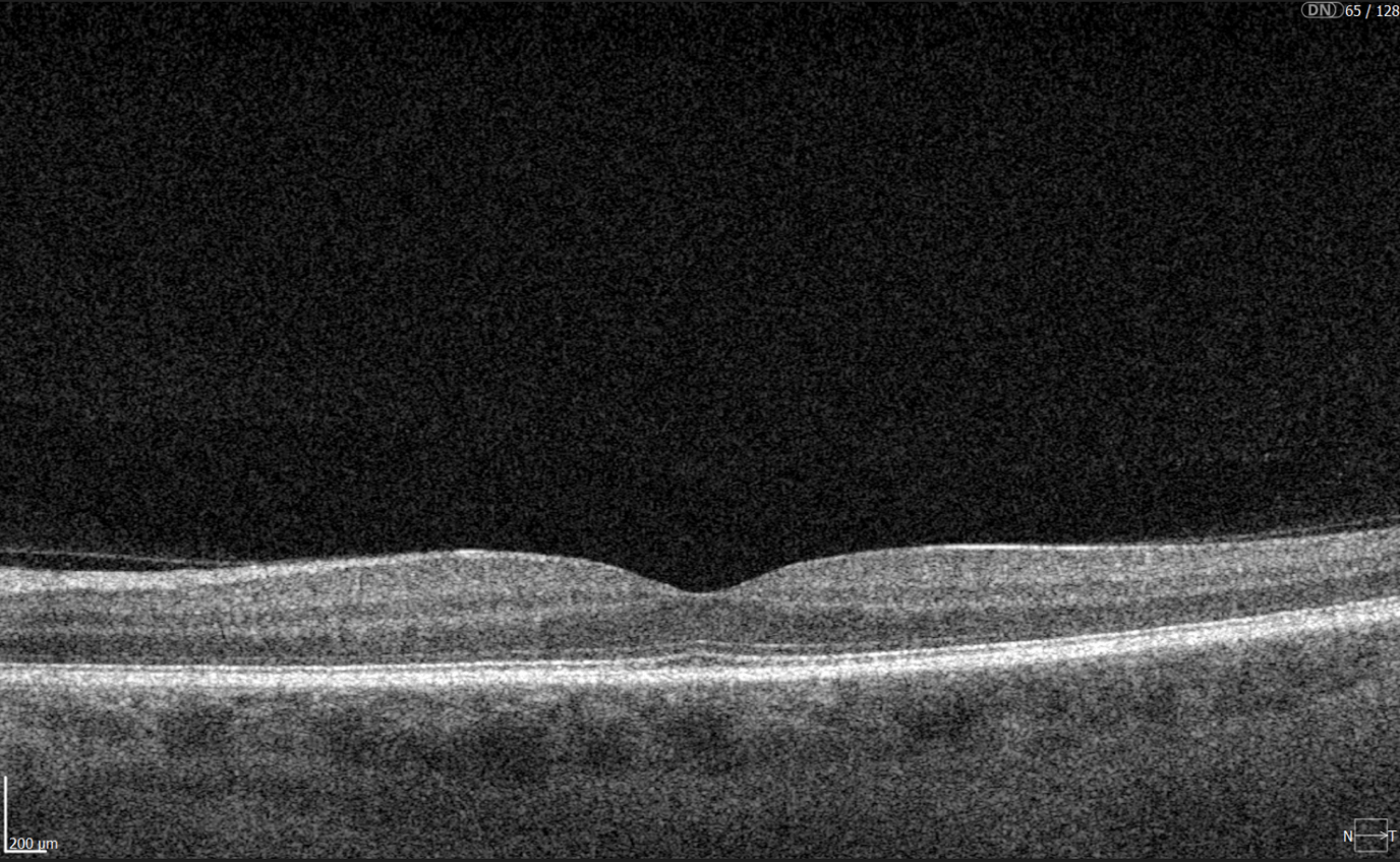 ai oct optic disc analysis