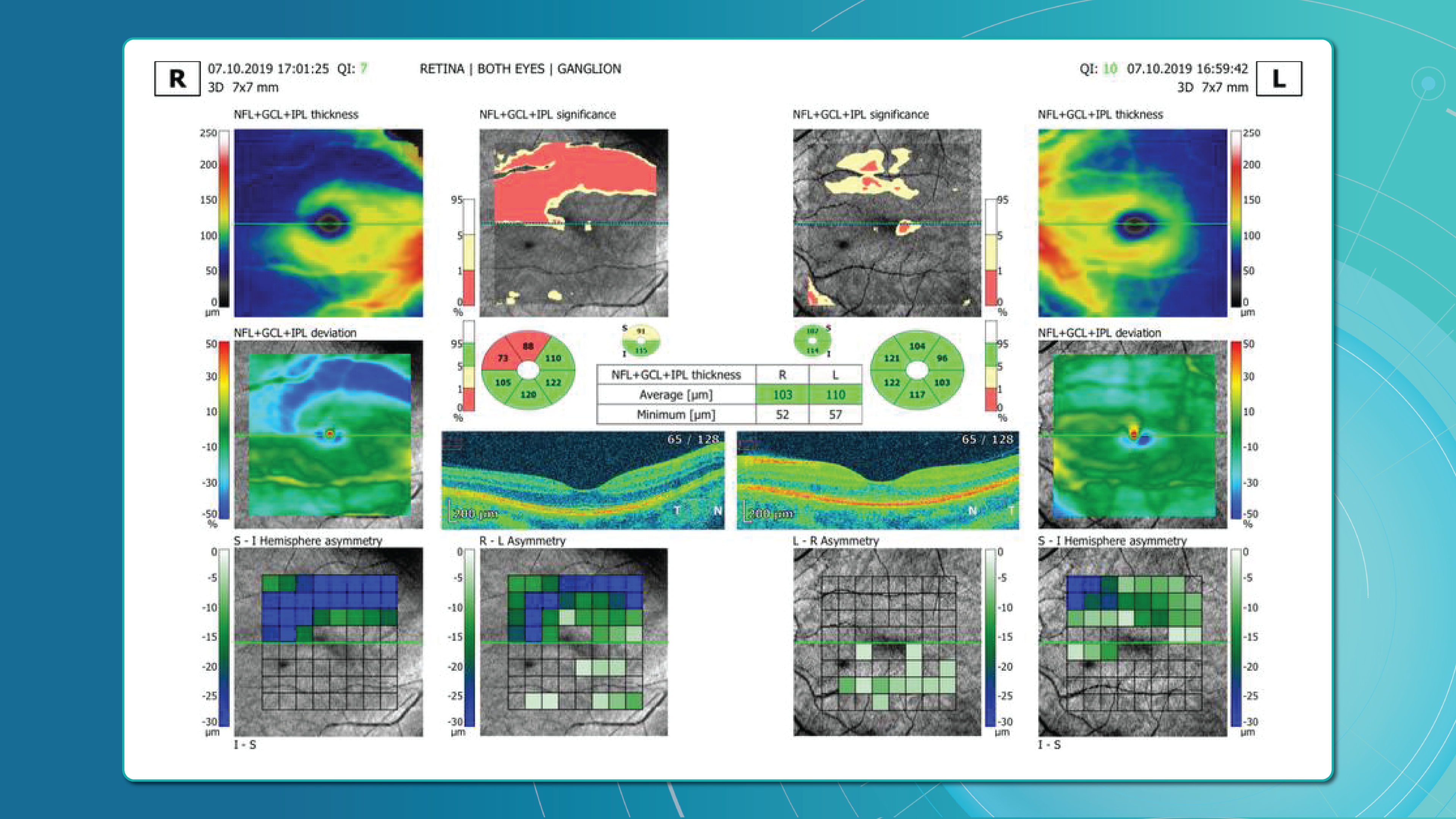 Measuring Ganglion Cell Complex (GCC) Thickness and GCC Asymmetry