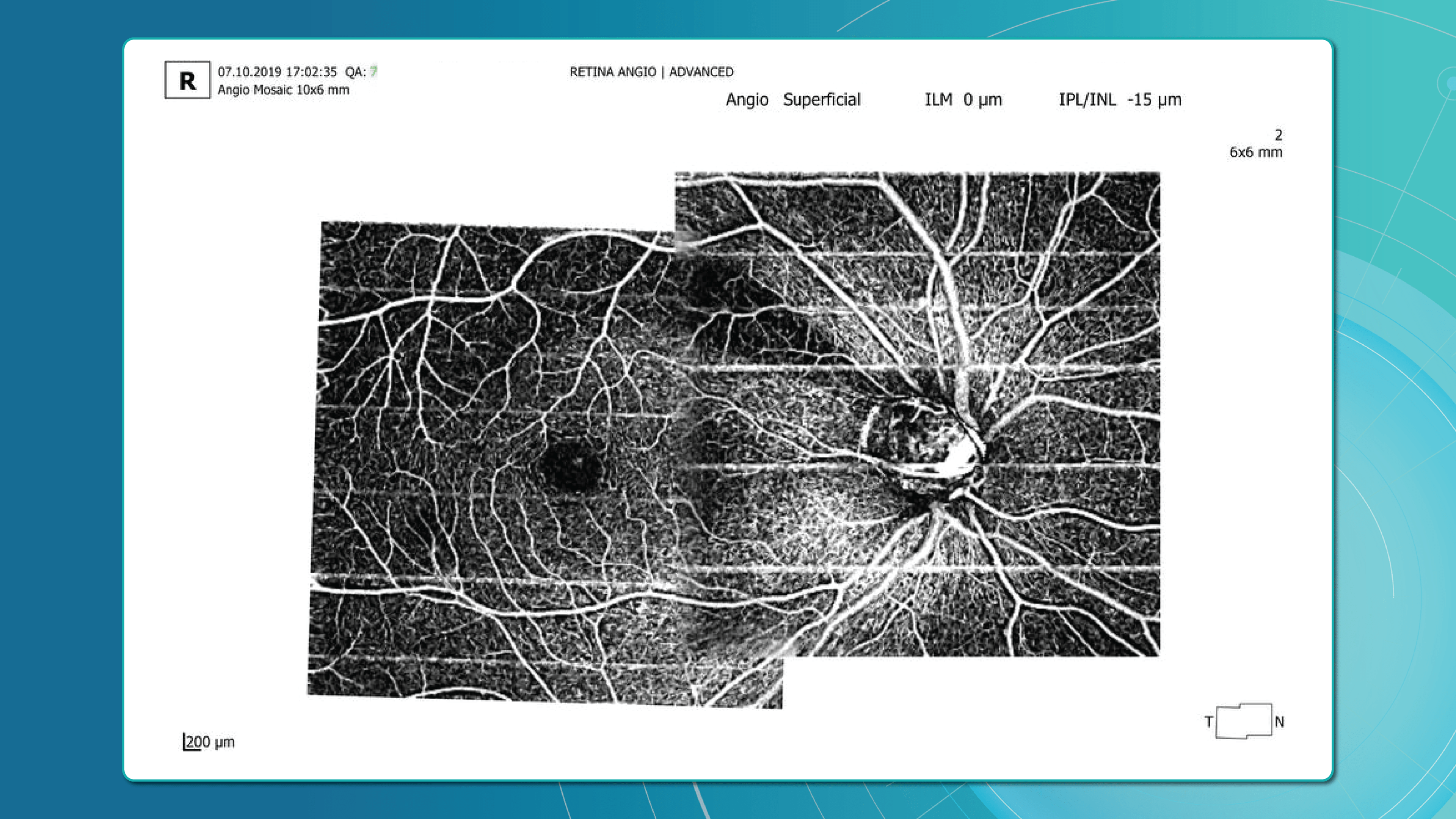 OCTA for early glaucoma detection 