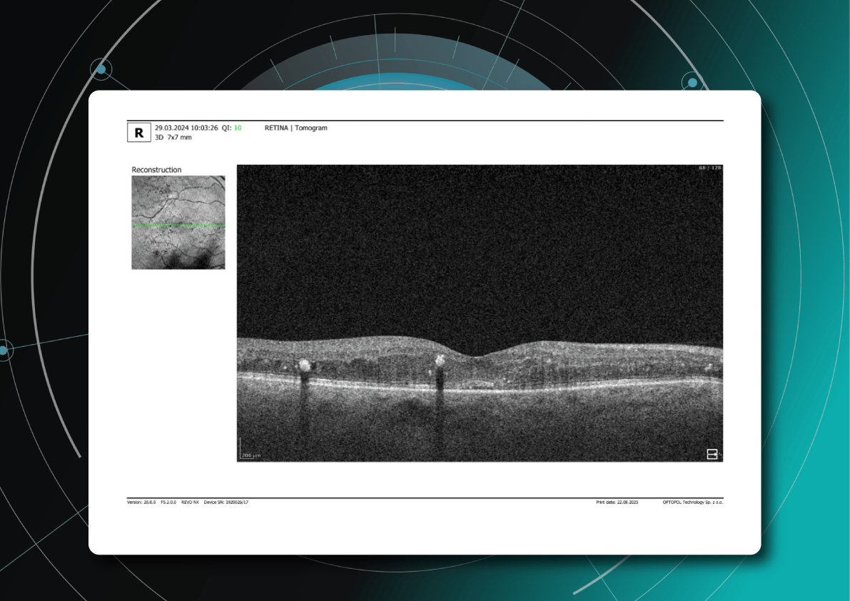 OCT biomarkers in DME