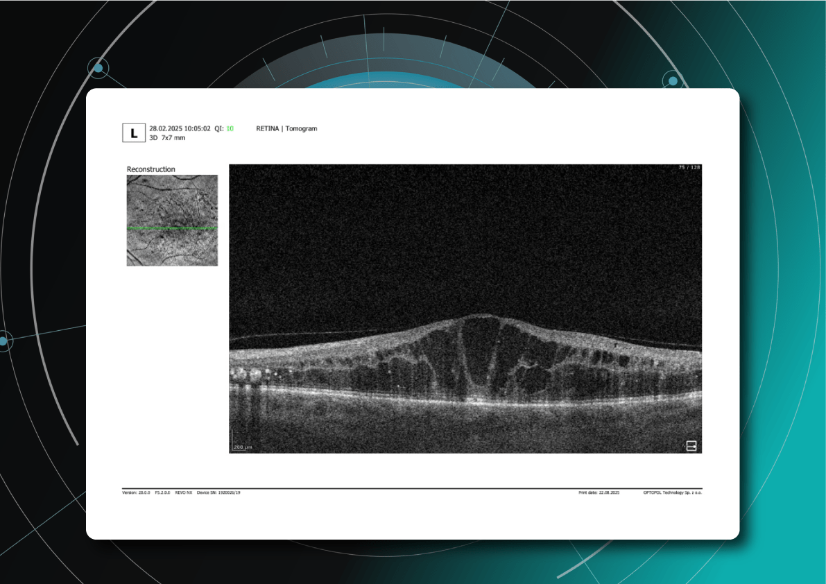 DME screening as the process of DR screening