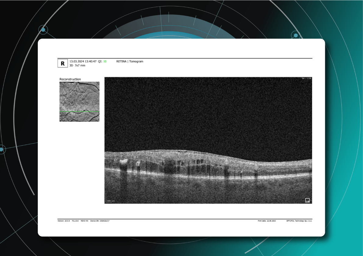 Screening DR with OCT
